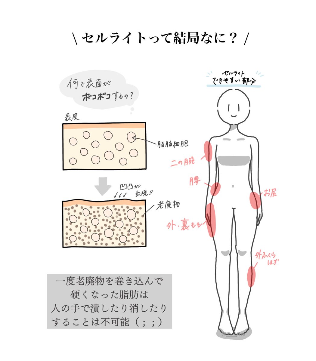 脚細くなったように見えても、実はまだまだセルライト蓄えてます……(見えるかな)仕組みについてイラスト描いてみたけど、人力では本当に落とせないの😭

先日有名なBTBでセルライトケアしてもらったけど、身体の状態を触って確かめてから、それに沿って20レベルあるマシンでじっくり解されたよ◎ https://t.co/QxKCPlqwzf 