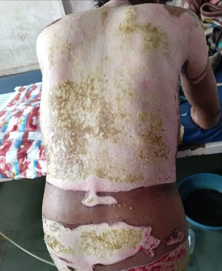 UntoldCares's tweet photo. इनका नाम जुबैरा खातून है जो 1 महीना पहले 75% जल चुकी है, पति गूंगा है, छोटे छोटे 2 बच्चे हैं। कटिहार मेडिकल कॉलेज बिहार में इलाज चल रहा है। इलाज के लिए पैसे नहीं है। मदद हेतु गुहार लगाई है।
@SonuSood सर @SoodFoundation @MrFirozKhan https://t.co/UmXkRQlNQK