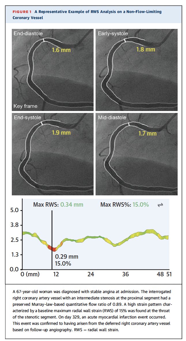 DrDamluji's tweet photo. 1/4 A novel coronary wall strain analysis, available solely from angiograms, known as RWS was develeped in this study. A post hoc analysis of FAVOR III China trial shows the discriminative value of RWS for predicting adverse events related to nonischemic vessels. https://t.co/sSfmXhxHoz
