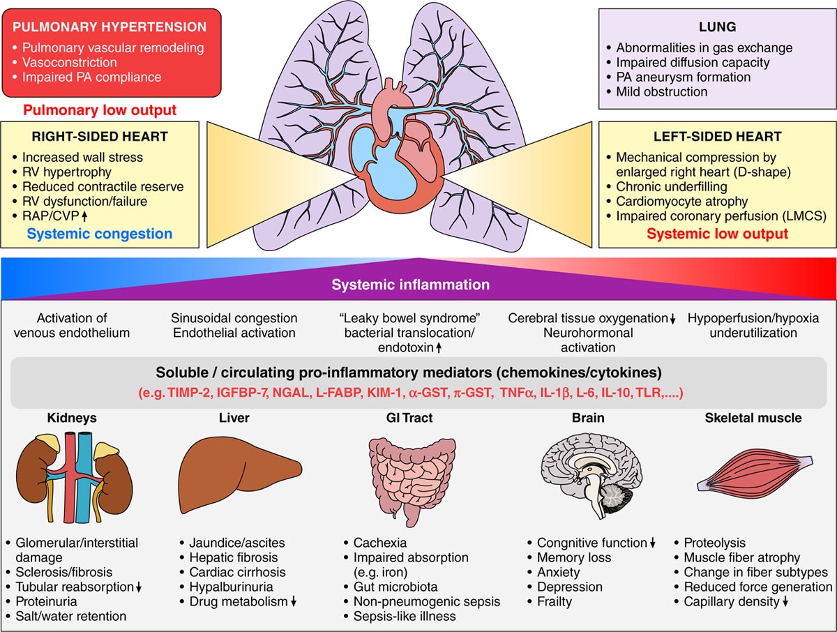 Systemic consequences of pulmonary hypertension and right-sided #HeartFailure 
🔗ahajournals.org/doi/full/10.11…….
#MedEd #POCUS #FOAMed 
CVP = central venous pressure; GI = gastrointestinal; LMCS = left main compression syndrome; PA = pulmonary artery, RAP = right atrial pressure