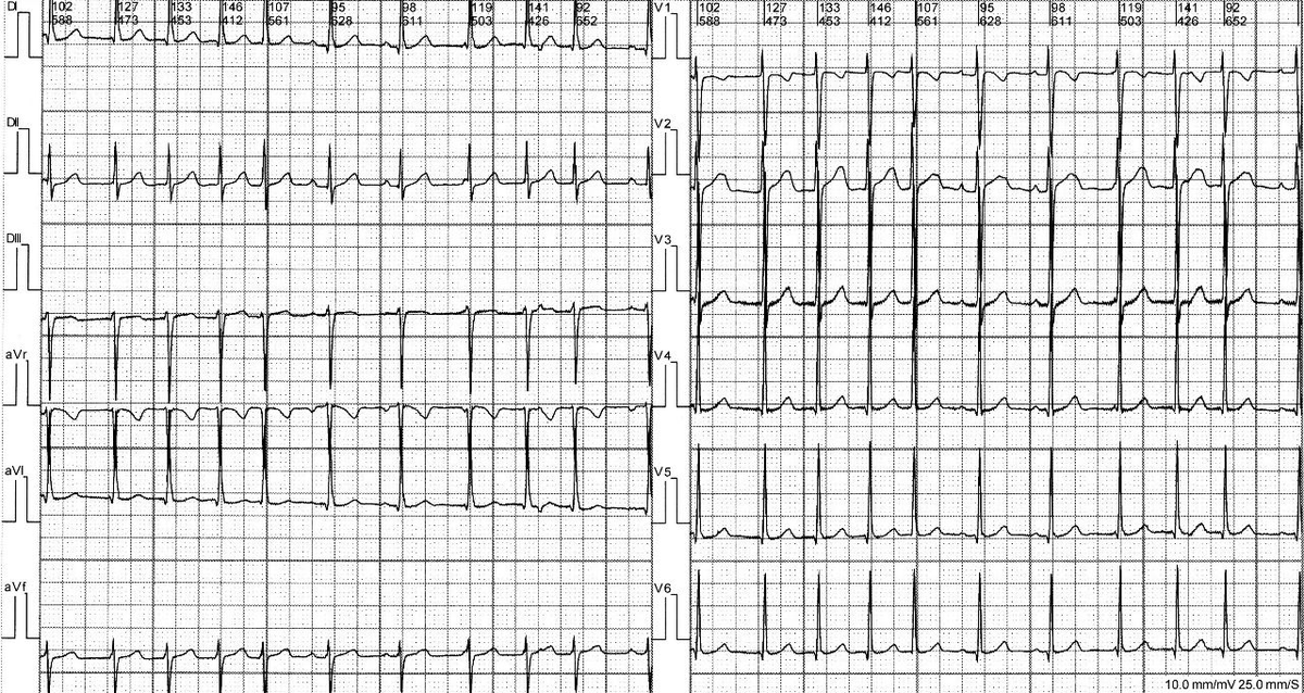 ComiteIcr's tweet photo. 📌Nuevo Desafio Electrocardiografico ICR💡
➡️Mujer de 15 años con palpitaciones paroxísticas en resposo. Sin cardiopatía estructural. ¿Diagnóstico probable?  Opciones en próximo tweet 👉 https://t.co/XyG5eKSOtn