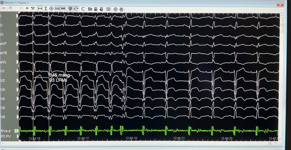 Dra_Jaurrigan's tweet image. Incessant slow #VT with intramural circuit in end-stage HCM despite previous #VTablations. Coil insertion in a small branch of 2nd diagonal coronary artery. CT integration in the #EPlab❤️ at Miguel Servet University Hospital. #EPeeps @EPeeps_Bot @secardiologia @escardio