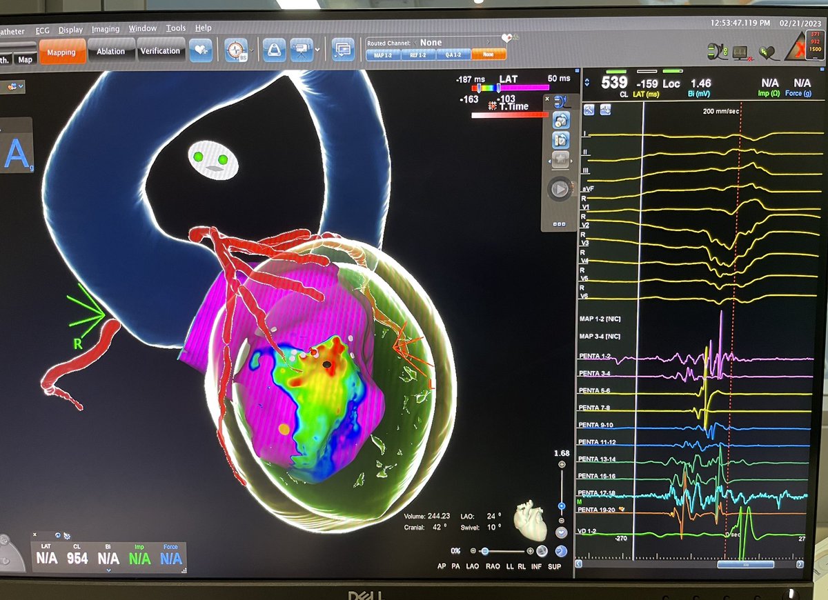 Dra_Jaurrigan's tweet image. Incessant slow #VT with intramural circuit in end-stage HCM despite previous #VTablations. Coil insertion in a small branch of 2nd diagonal coronary artery. CT integration in the #EPlab❤️ at Miguel Servet University Hospital. #EPeeps @EPeeps_Bot @secardiologia @escardio