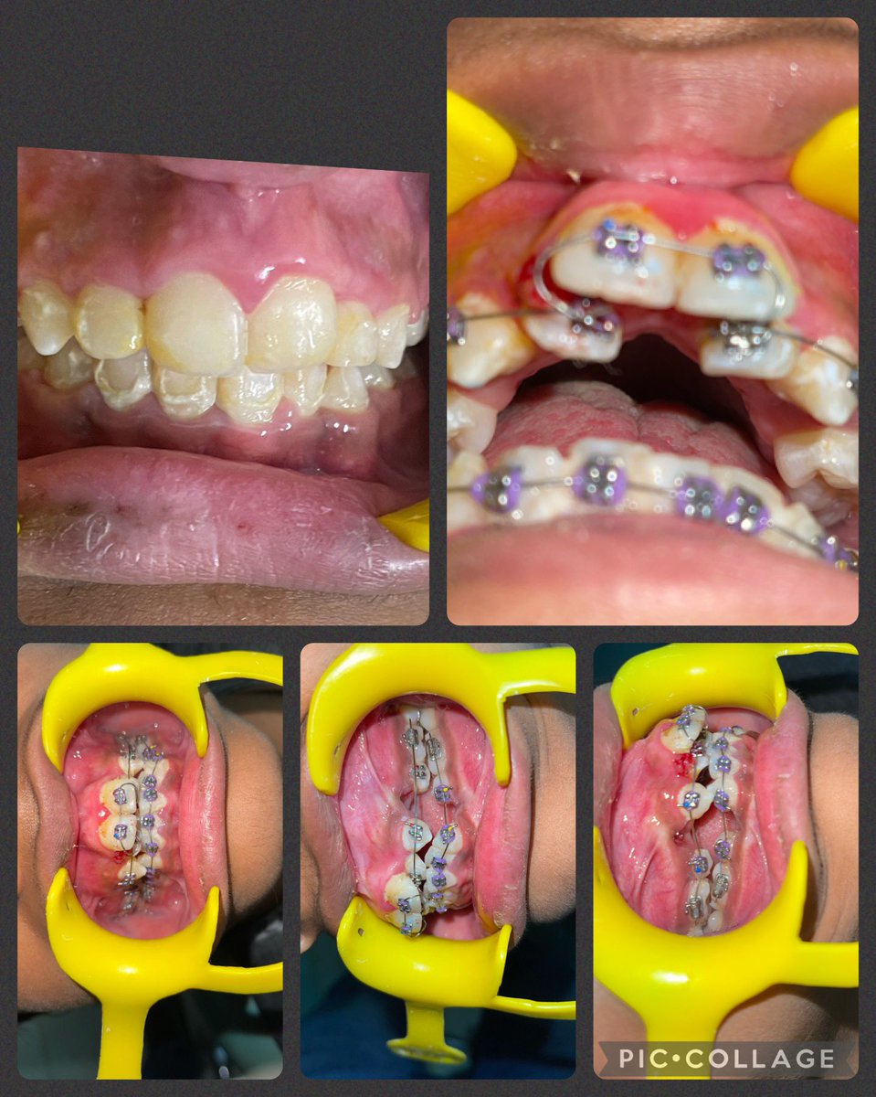 DrMohit07's tweet image. *Braces not only gives you beautiful smile but confidence also……….*

#orthodontictreatment #smile #deepbite #crowding #malocclusion #braces #orthodontia #smilemakeover #perfectocclusion