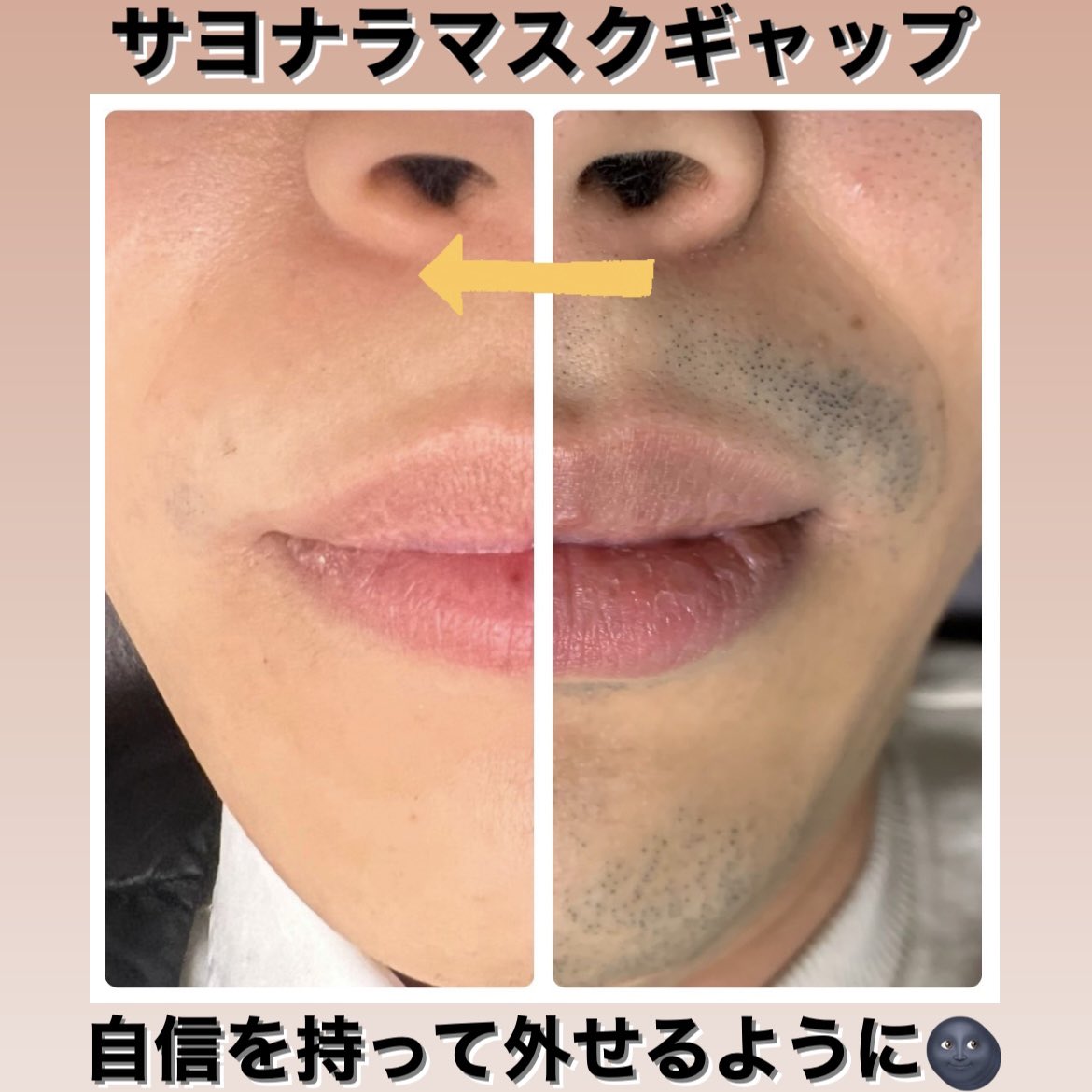 le_falco_'s tweet photo. #脱毛 #大阪脱毛 #脱毛サロン #光脱毛 #全身脱毛 #VIO脱毛 #部分脱毛 #ヒゲ脱毛 #髭 #メンズ脱毛 #痛くない脱毛 #フォトフェイシャル #美肌 #美顔 #プライベートサロン #北区 #梅田 #東梅田 #北新地 #西天満 #南森町 #中崎町 #子供脱毛 #ジェルなし #neqst https://t.co/plFbdTK4t3