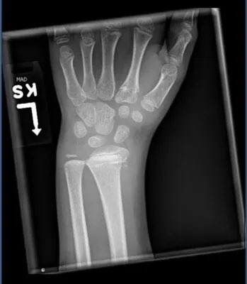 orthoEMpearls's tweet image. Monkey bar mania! What is the diagnosis and management? #FOAMed #FOAMrad #EmergencyMedicine 

Full details of the case Wed including our new Orthopedic Commentary!