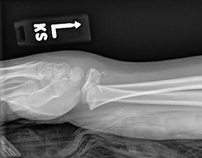 orthoEMpearls's tweet image. Monkey bar mania! What is the diagnosis and management? #FOAMed #FOAMrad #EmergencyMedicine 

Full details of the case Wed including our new Orthopedic Commentary!