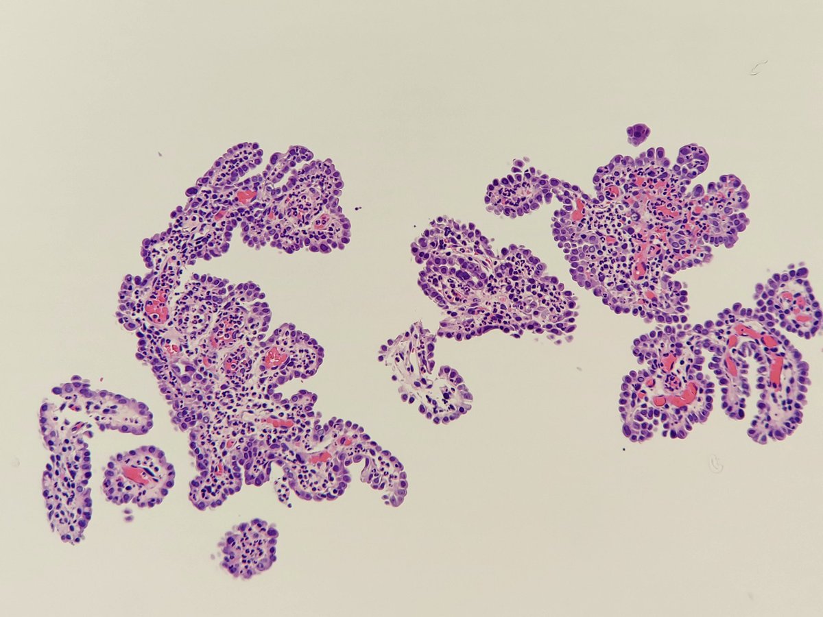This is a biopsy of a ureteral mass at the anastomosis site from a prior partial ureterectomy for urothelial carcinoma. Should this patient get a nephroureterectomy? Anyone want any stains?           #pathology #pathresidents #gupathology