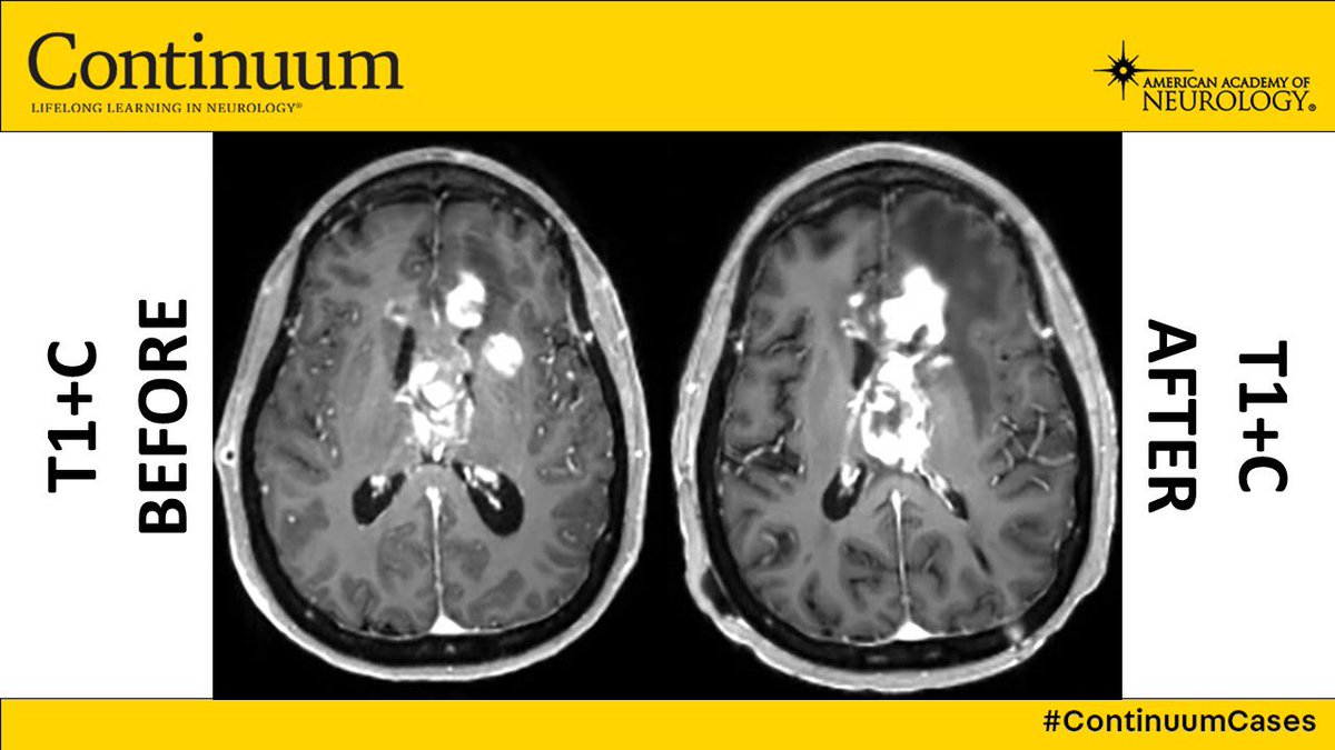 LyellJ's tweet photo. Neuroimaging #ContinuumCase (trying to keep up with @caseyalbin!)

A patient with IDH wild-type glioblastoma undergoes chemoradiotherapy. At 2 months, the left frontal tumor looks a bit worse

Is this tumor progression #neurotwitter, or an effect of treatment?🧵 https://t.co/3lLZNAoAjb
