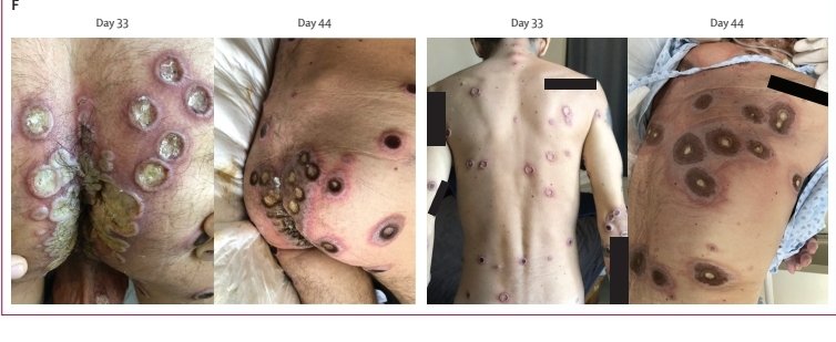 Our study <a href="/TheLancet/">The Lancet</a> bit.ly/3Zd3Wzm on mpox in individuals with advanced HIV shows it was associated with more severe disease &amp; high mortality 1/6