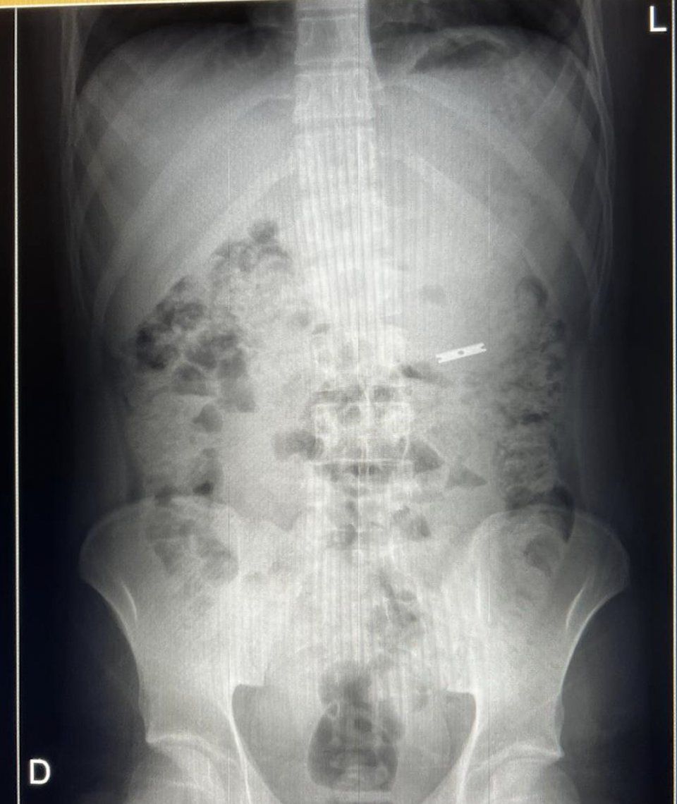 Psychia02961114's tweet photo. Un menor disocial hospitalizado contra su voluntad en el psiquiátrico infantil se trago en 3 ocasiones distintas objetos punzocortantes requiriendo cirugías de urgencia. La decisión de la autoridad es sujetarlo y sedarlo. ¿Para qué se hizo la ley?
@CNDH @YoTambien @Pajaropolitico https://t.co/uW6s03Euwt