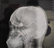 suryacommand's tweet photo. #IndianArmy
In a pioneering surgery, #SuryaHealers
rehabilitated a young patient's skull defect using advanced 3D printing technology for titanium cranioplasty repair. They join an elite group in the #Country to successfully accomplish this procedure. 
@adgpi
@ProDefLko https://t.co/TMhV78EIMK