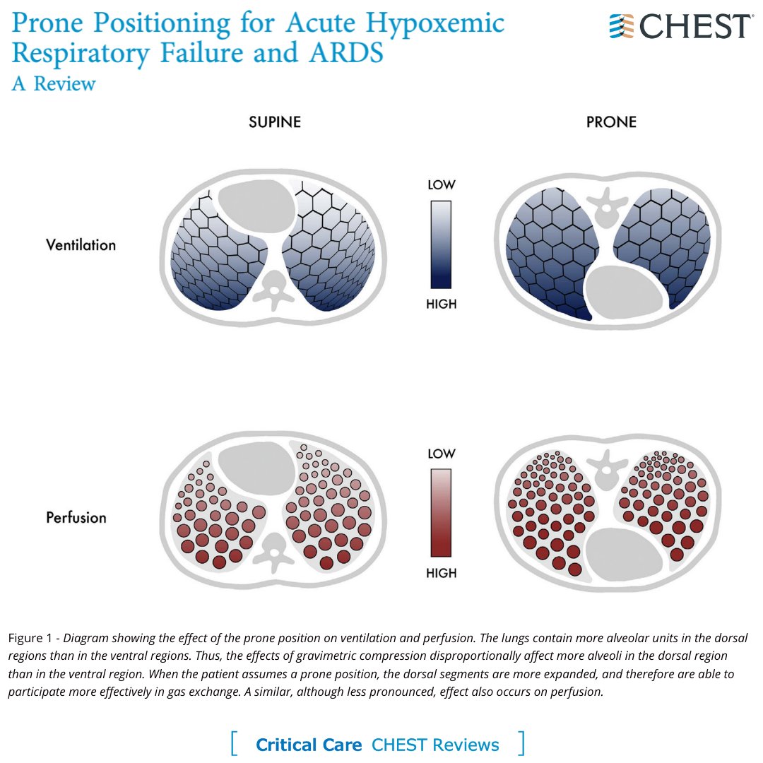 journal_CHEST's tweet photo. "Belly down, sats up!" Read this CHEST Review to learn more about #PronePositioning. Read the full research in the February issue: https://t.co/pk0St0Cl8l
#MedTwitter #CritCare #MedEd https://t.co/bfNEvQo4Sa