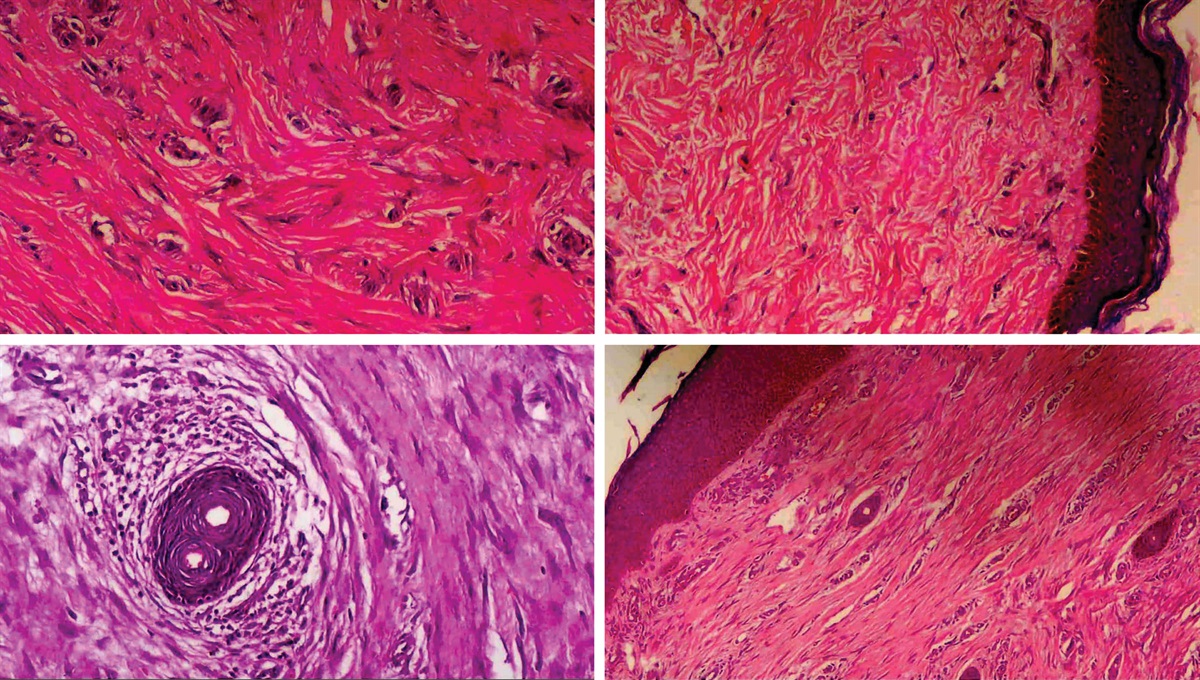 prsjournal's tweet photo. Trending in PRS: Hypertrophic Scars of the Hand: The Role of Electrophotobiomodulation Theory as a Recent Line of Treatment https://t.co/LGG3sjs2Nt #plasticsurgery #PRSJournal https://t.co/CYPH19hsiR