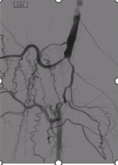 reflowmedical's tweet photo. After 2 antegrade/retrograde crossing attempts failed, Dr Jihad A Mustapha uses a Wingman 35 for first-line crossing of a CTO of the distal SFA, proximal popliteal arteries in <5 minutes, staying in true lumen. https://t.co/wEqvWhTcT6 #interventionalcardiologist #CLIFighters https://t.co/9njKOQbQDr