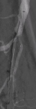reflowmedical's tweet photo. After 2 antegrade/retrograde crossing attempts failed, Dr Jihad A Mustapha uses a Wingman 35 for first-line crossing of a CTO of the distal SFA, proximal popliteal arteries in <5 minutes, staying in true lumen. https://t.co/wEqvWhTcT6 #interventionalcardiologist #CLIFighters https://t.co/9njKOQbQDr