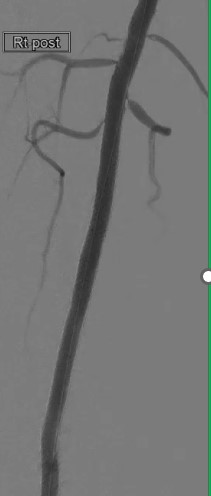 reflowmedical's tweet photo. After 2 antegrade/retrograde crossing attempts failed, Dr Jihad A Mustapha uses a Wingman 35 for first-line crossing of a CTO of the distal SFA, proximal popliteal arteries in <5 minutes, staying in true lumen. https://t.co/wEqvWhTcT6 #interventionalcardiologist #CLIFighters https://t.co/9njKOQbQDr