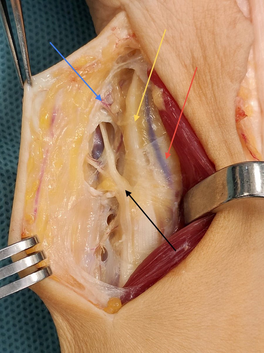 Nervio mediano multioperado 

3️⃣ cirugías previas por compresión túnel carpiano 
▪️Exoneurolisis Microquirúrgica 🔬extensa
▪️Cobertura 360 grados mediante colgajo Fasciograso de Becker
▪️Perforante dorso-ulnar de la arteria cubital