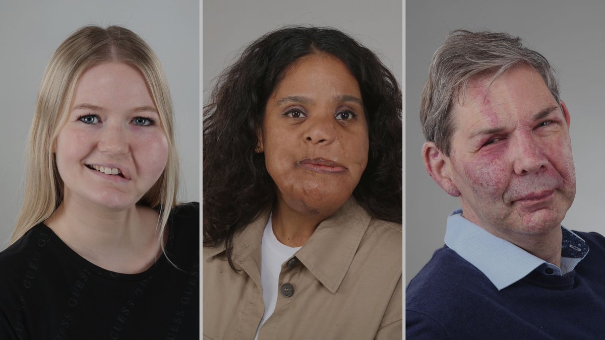 In 2022 heeft HEVAS hard gewerkt aan het maken van drie video's over zichtbare aandoeningen. Patiënten, ouders en een psycholoog delen ervaringen en tips over hoe om te gaan met een zichtbare aandoening. Lees meer en bekijk de video's op onze website: hevas.eu/videos-over-zi…