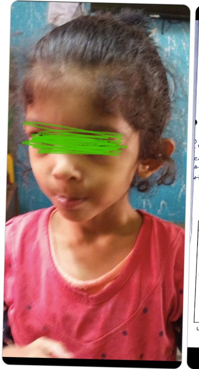 MahisagarRbsk's tweet photo. CHD child opereted at U N Mehata  hospital, Ahmedabad on 11/02/2023.                                   
 Birth Date:08/06/2017
Balasinor,
SH-RBSK MAHISAGAR @PMOIndia @CMOGuj @MoHFW_GUJARAT @GujHFWDept @Rushikeshmla https://t.co/BDFlDsQnnu