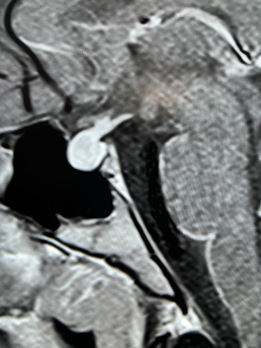 Tip of the day 💡: The pituitary and it’s stalk can enlarge and enhance like this during puberty. Physiology is a range of normality.