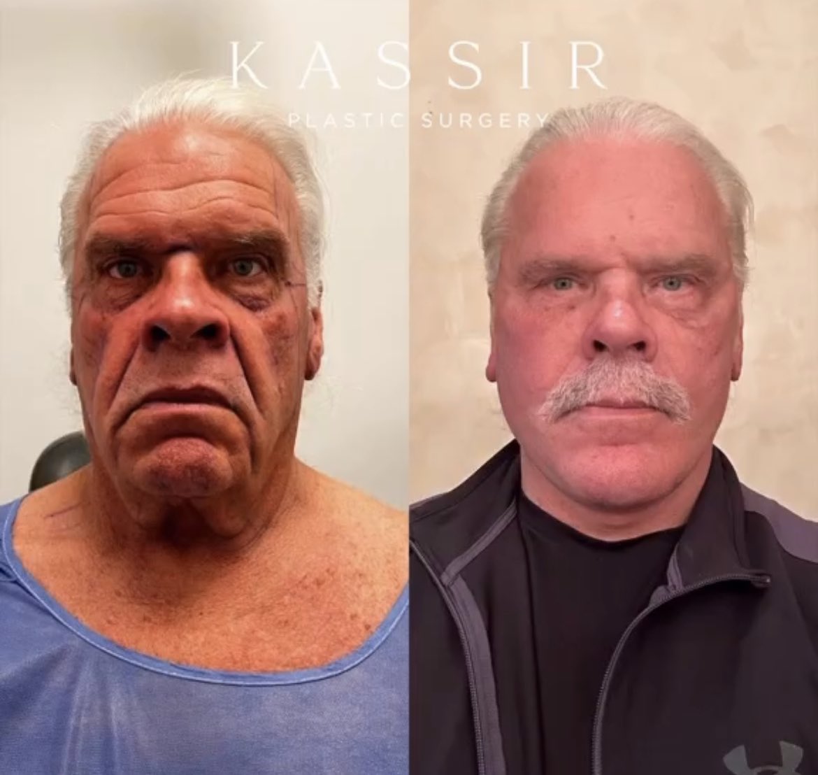 Full Face Rejuvenation ✨

This amazing 70 year old patient is ONLY 2 weeks post op

He had a:
Deep Plane Face & Neck Lift
Endoscopic Forehead & Brow Lift
Revision Upper & Lower Blepharoplasty Fat Transfer to Face
Fractional CO2 Laser
Septo-Rhinoplasty
Chin Implant