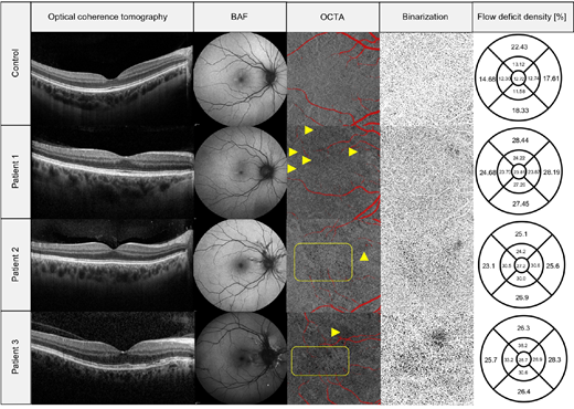 Kristina Pfau <a href="/KristinaHessMD/">KHess</a> et al. <a href="/UniklinikBonn/">Uniklinik Bonn</a> quantify choriocapillaris flow alterations in patients with pseudoxanthoma elasticum (PXE) in pre-atrophic stages and its association with structural changes of the choroid and outer retina.
doi.org/10.1167/iovs.6…