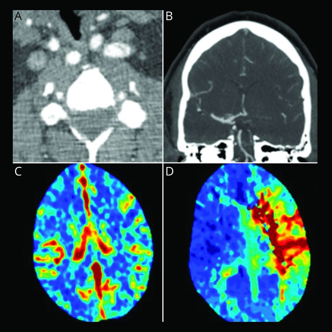 NeurologyCP's tweet photo. Intimal sarcoma is an extremely rare cause of large vessel obstruction stroke and can be identified by a routine histopathologic analysis of all embolectomy specimens. Learn more: https://t.co/a1Q6TbaAID

#NeuroTwitter https://t.co/QqB0Cv1vpx