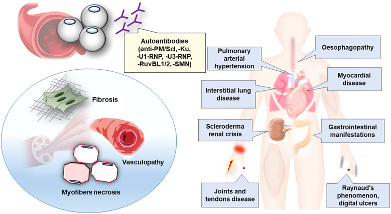 Review on scleromyositis:
- No validated definition.
- Aldolase is more frequently elevated than CK.
- Antibodies: anti-PM/Scl, -Ku, -U1-RNP, -U3-RNP, - RuvBL1/2, -SMN
- Muscle biopsy: Vasculopathy, fibrosis, myofiber necrosis.
- Be careful with steroids and SSc renal crisis.