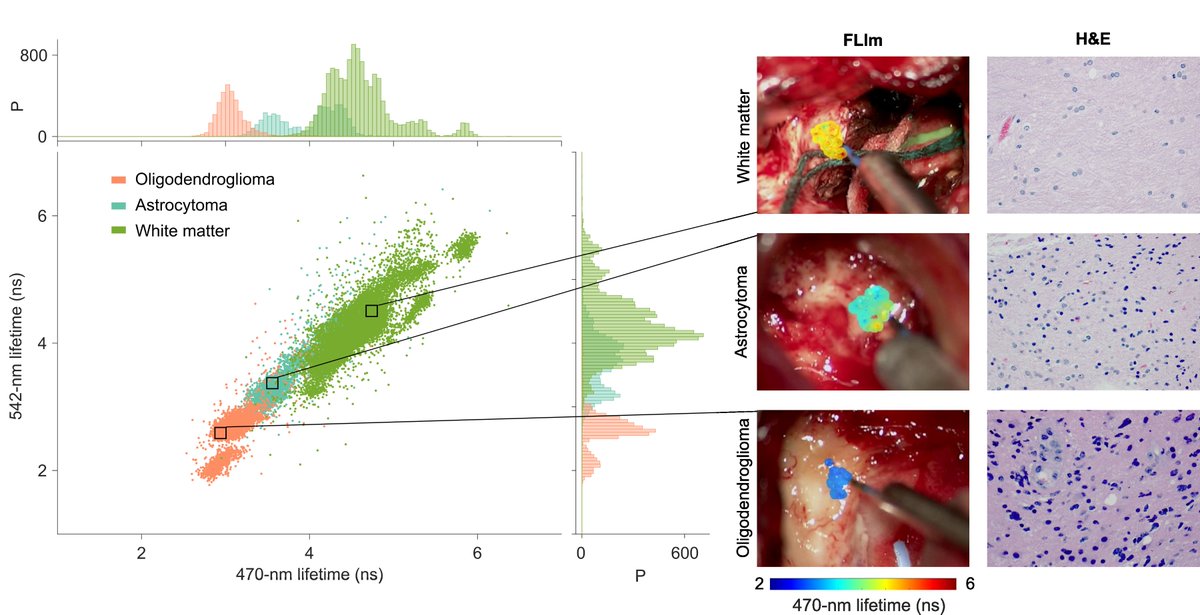 Have you seen our new paper: "Intraoperative detection of IDH-mutant glioma using fluorescence lifetime imaging" doi.org/10.1002/jbio.2…