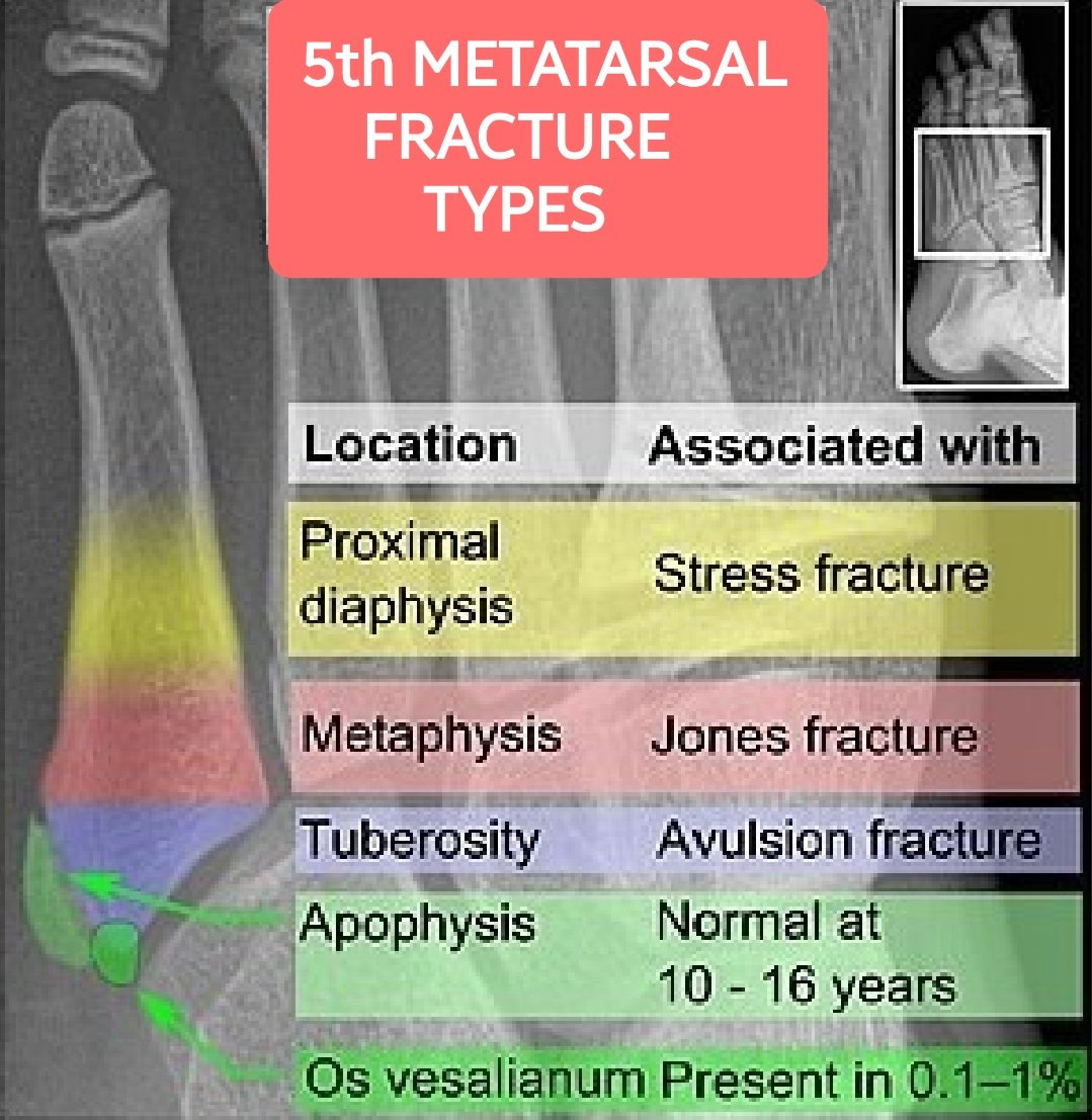🛑The common differential diagnoses of 5th Metatarsal fractures beautifully demonstrated based on the exact locations.
●A Jones Fx. 
●Stress fx.
●Avulsion Fx of proximal 5th metatarsal. 
●Os vesalianum.
●Normal apophysis.
●Iselin disease(apophysitis)
aerzteblatt.de