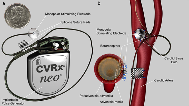 🚨News for the #Interventional_HF Space:

ir.cvrx.com/news-releases/…

While the trial did not reach statistical significance on the primary endpoint, it did contain additional clinically meaningful prespecified analyses that favored Barostim, including: