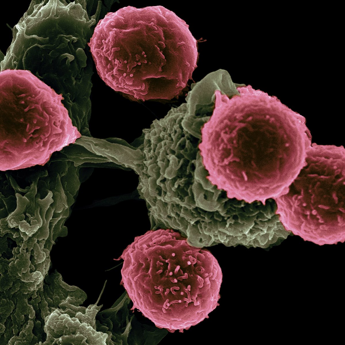 MedPipeline's tweet photo. How much does Tecartus cost? Chimeric antigen receptor (CAR) T-cell therapy is an #immunotherapy that uses a patient’s own genetically modified T cells (white blood cells), to find and kill cancer. It's an advanced treatment, but it's costly. https://t.co/7Bf4cdrp8p #Tecartus https://t.co/WKdKxH5xFk