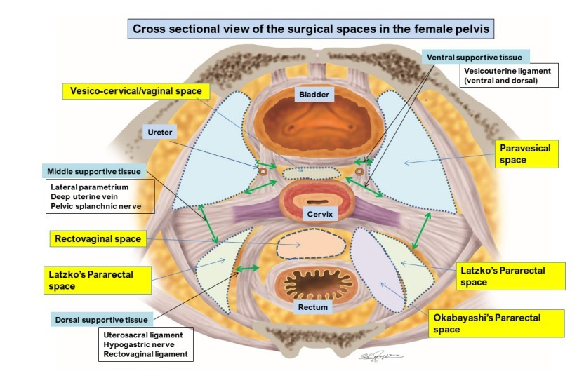 IJGConline's tweet photo. Refresh your #radical #hysterectomy anatomy with the comprehensive review on #avascular spaces @ https://t.co/akW9pE9Wbh
@pedroramirezMD @HsuMd @JayrajAarthi @AndreFernandes2 @agz_eriksson @IGCSociety @ESGO_society @ENYGO_official @OncoAlert @IJGCfellows @GynMe4 https://t.co/70cuQEGV3Y
