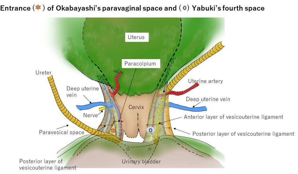 Refresh your #radical #hysterectomy anatomy with the comprehensive review on #avascular spaces @ bit.ly/3K8vNwx

<a href="/pedroramirezMD/">Pedro T Ramirez</a> <a href="/HsuMd/">Arthur_HC_Hsu</a> <a href="/JayrajAarthi/">Aarthi S Jayraj</a> <a href="/AndreFernandes2/">Andreina Fernandes</a> <a href="/agz_eriksson/">Ane Gerda Z Eriksson MD PhD</a> <a href="/IGCSociety/">IGCS</a> <a href="/ESGO_society/">ESGO</a> <a href="/ENYGO_official/">European Network of Young Gynae Oncologists</a> <a href="/OncoAlert/">OncoAlert</a> <a href="/IJGCfellows/">IJGC Fellows</a> <a href="/GynMe4/">SoMe4GynOnc</a>