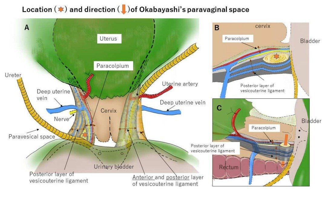 IJGConline's tweet photo. Refresh your #radical #hysterectomy anatomy with the comprehensive review on #avascular spaces @ https://t.co/akW9pE9Wbh
@pedroramirezMD @HsuMd @JayrajAarthi @AndreFernandes2 @agz_eriksson @IGCSociety @ESGO_society @ENYGO_official @OncoAlert @IJGCfellows @GynMe4 https://t.co/70cuQEGV3Y