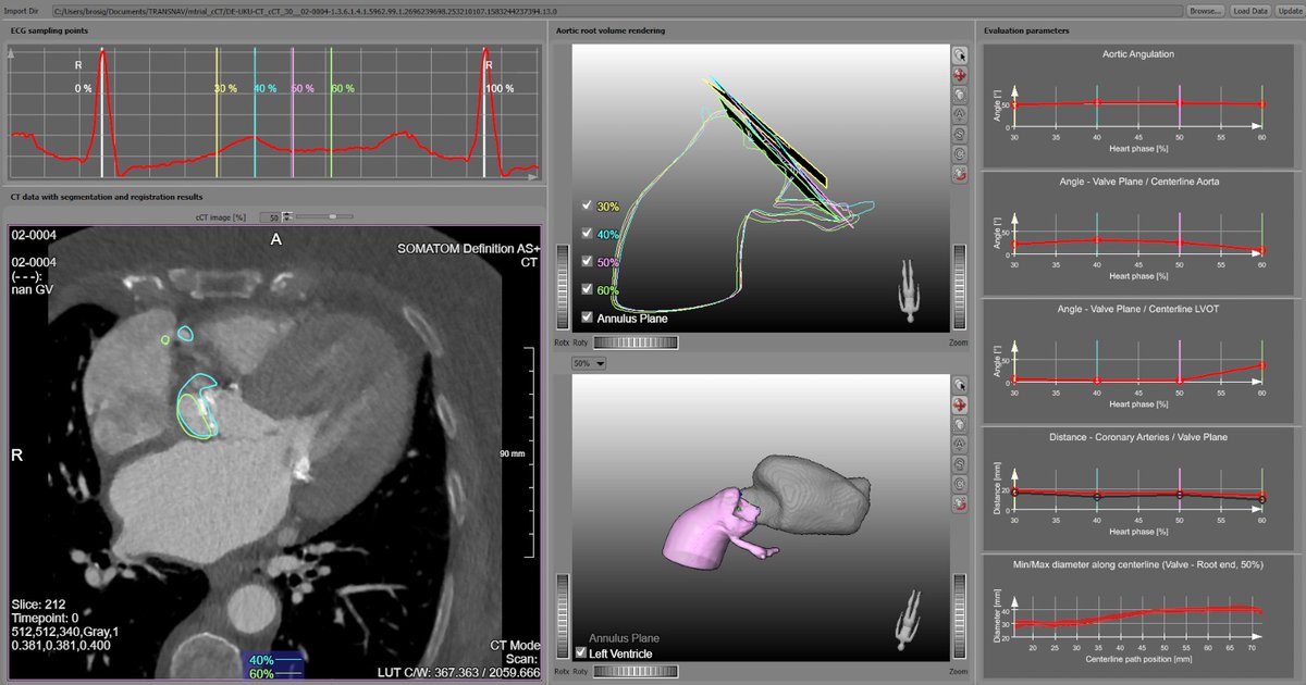 FraunhoferMEVIS's tweet photo. Assessment of #anatomicalStructures and position uncertainty for transcatheter #aorticValveImplantation: find out more in our live demo today 18:00 at #SPIEMedicalImaging. https://t.co/e0JrWZvLTw
#cardiacCT https://t.co/iTXFVzsLzu
