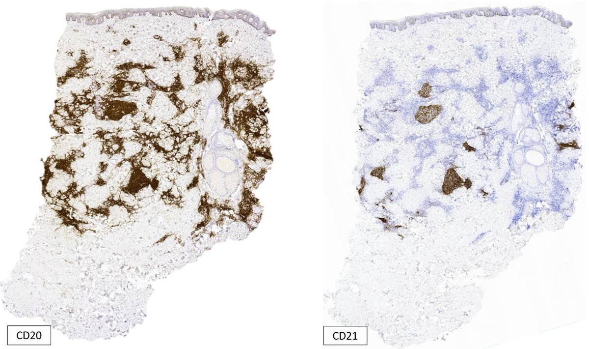 SibaElHussein's tweet photo. Primary cutaneous follicle centre lymphoma:

🩸Perivascular/periadnexal follicular or diffuse infiltrate, sparing the epidermis
 🩸Histologic grading not applicable
🩸Many cases may show large multilobated cells +  increased admixed centroblasts➡️May look scary

#hemepath #lymsm https://t.co/H9bjVi1Zk9
