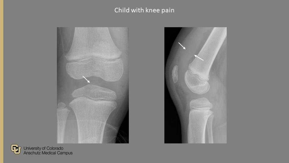 PedsRadsColo's tweet photo. @PedsRadsColo Weekly #QualityRounds:

Child with knee pain

#ImagingOurFuture #PedsRad #MedEd #RadRes #FOAMrad #FOAMed #GoodCall #PeerLearning #RadTwitter

@COpediatricEM @SocPedRad @CURadiology @curadresidents https://t.co/FhtKDhlFBJ