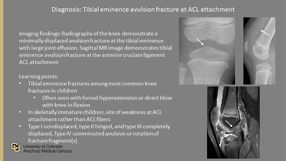 @PedsRadsColo Weekly #QualityRounds:

Child with knee pain

#ImagingOurFuture #PedsRad #MedEd #RadRes #FOAMrad #FOAMed #GoodCall #PeerLearning #RadTwitter

@COpediatricEM @SocPedRad @CURadiology @curadresidents