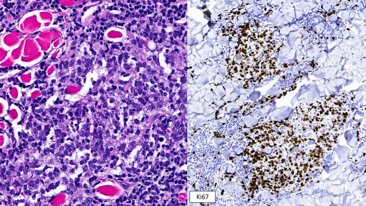 SibaElHussein's tweet photo. Primary cutaneous follicle centre lymphoma:

🩸Perivascular/periadnexal follicular or diffuse infiltrate, sparing the epidermis
 🩸Histologic grading not applicable
🩸Many cases may show large multilobated cells +  increased admixed centroblasts➡️May look scary

#hemepath #lymsm https://t.co/H9bjVi1Zk9