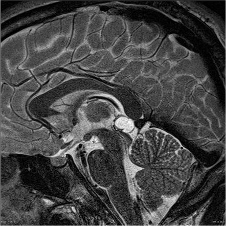 Daily #Neurosurgery Quiz Question 418: What MRI sequence is seen and what is the pathology seen in the image? Comment with your answer! Source: Frank Gaillard (@Radiopaedia)