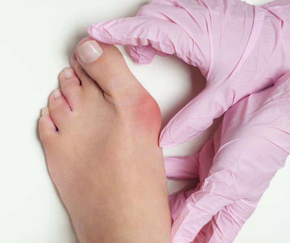 wehapodiatry's tweet photo. Is your painful bunion getting the best of you? Beat it once and for all with the help of the West Hartford team! Learn how you and your podiatrist can treat your bunion in our latest blog! https://t.co/DrcFdiqDd4 https://t.co/34QEQcUmjB