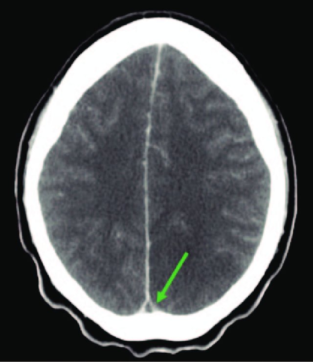 BasicNeurosurge's tweet image. Daily #Neurosurgery Quiz Question 420: 

What classic neuroradiographic sign is indicated by the arrow and what is the diagnosis? 

Comment with your answers!
Source: doi: 10.1093/jscr/rjt035