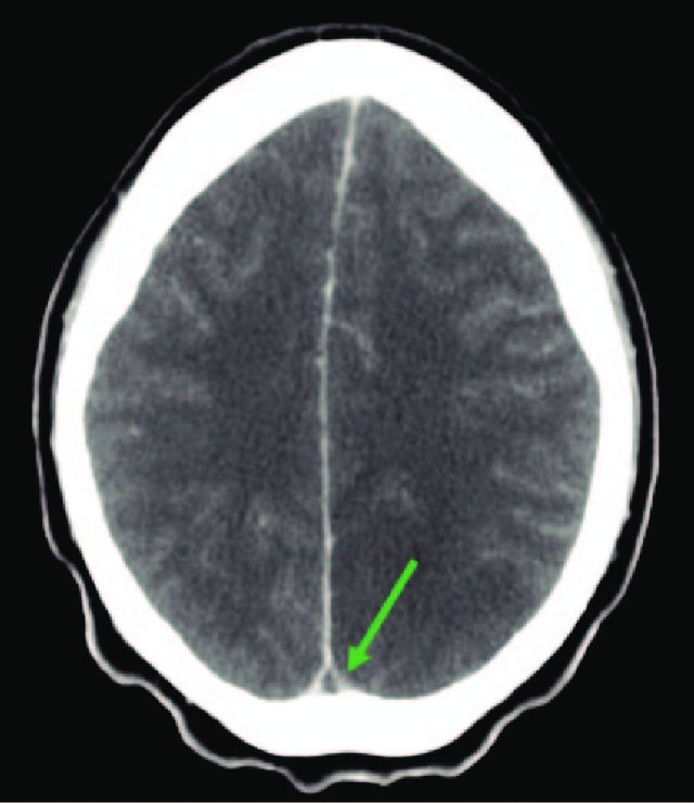 Daily #Neurosurgery Quiz Question 420: What classic neuroradiographic sign is indicated by the arrow and what is the diagnosis? Comment with your answers! Source: doi: 10.1093/jscr/rjt035