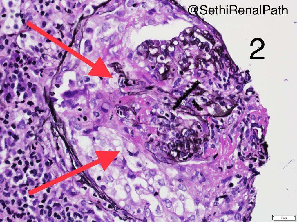 Two biopsies today- the diagnosis was made before labs were available.
1. AL amyloidosis. PAS stain showing PAS negative acellular amyloid deposits. Clinical impression membranous. Monoclonal Ig not done.
2. Crescentic & necrotizing GN. Huge crescents everywhere. ANCA not done.