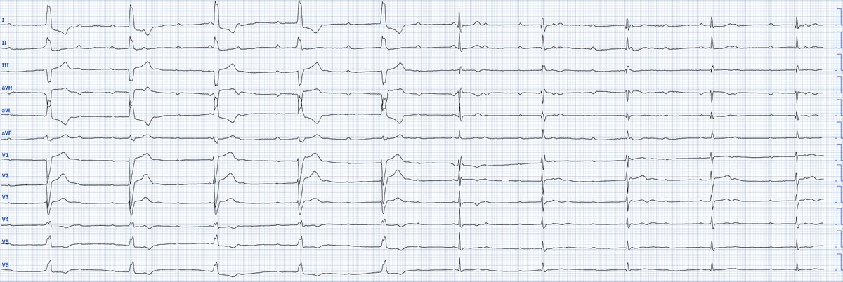 LopezLizarraga_'s tweet photo. BAV completo con un curioso ritmo de escape. Alterna morfología=>BRIHH, BRDHH y QRS estrecho; un sitio de escape del sistema Purkinje derecho => fascículos izquierdos => rama derecha proximal
Opiniones?
#PMcardio #FOAMed #ECG @JL_MoralesArt @LaloBarraganH @DidlakeDW @Yldifonso777 https://t.co/jzsUh0uvo5