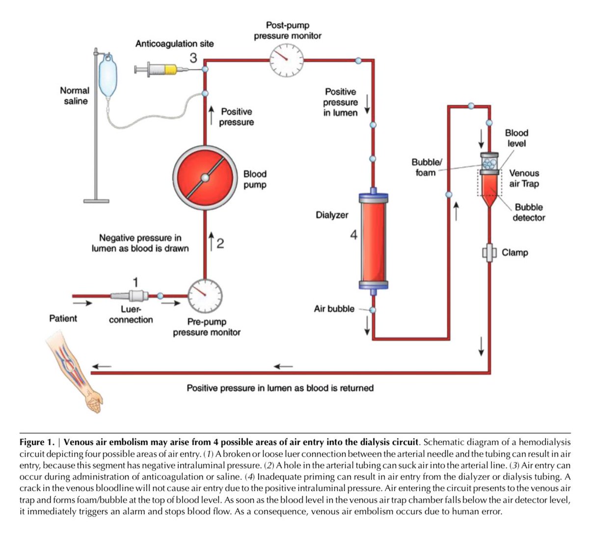 edgarvlermamd's tweet photo. Diagnosis, Treatment, and Prevention of Hemodialysis Emergencies π¨ ca. 2017 from @CJASN #Nephpearls #AskASN #NephJC
ππΌ https://t.co/Bv0hUCmf2F https://t.co/mwOVJNatEM