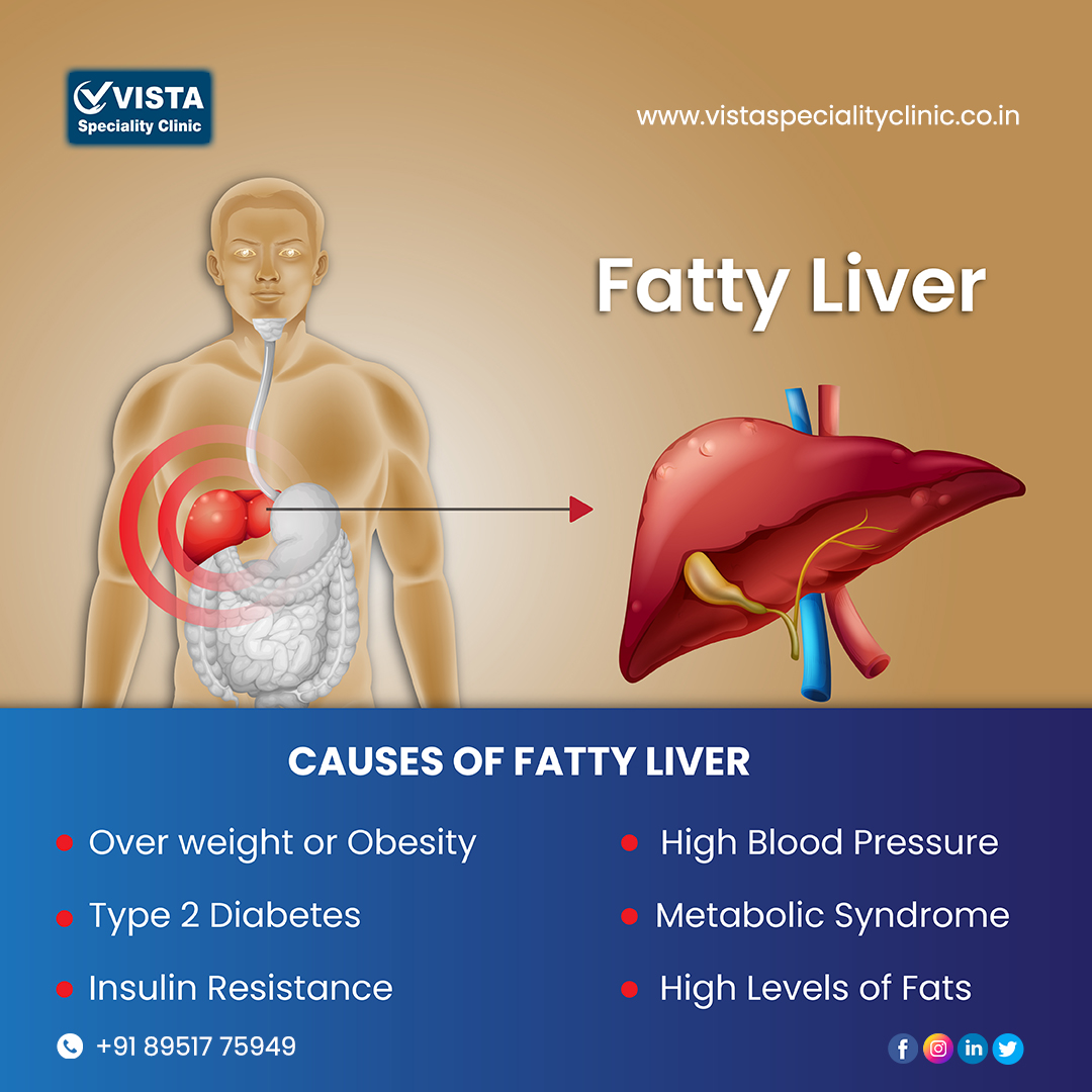 Vista Specialty Clinic offers a full range of treatment and diagnostic procedures for the treatment of various liver problems. Avoid waiting.

Book Doctor Appointment Online +91 8951 775949
Website: vistaspecialityclinic.co.in

#LiverProblems #LiverTreatment #VistaSpecialityClinic