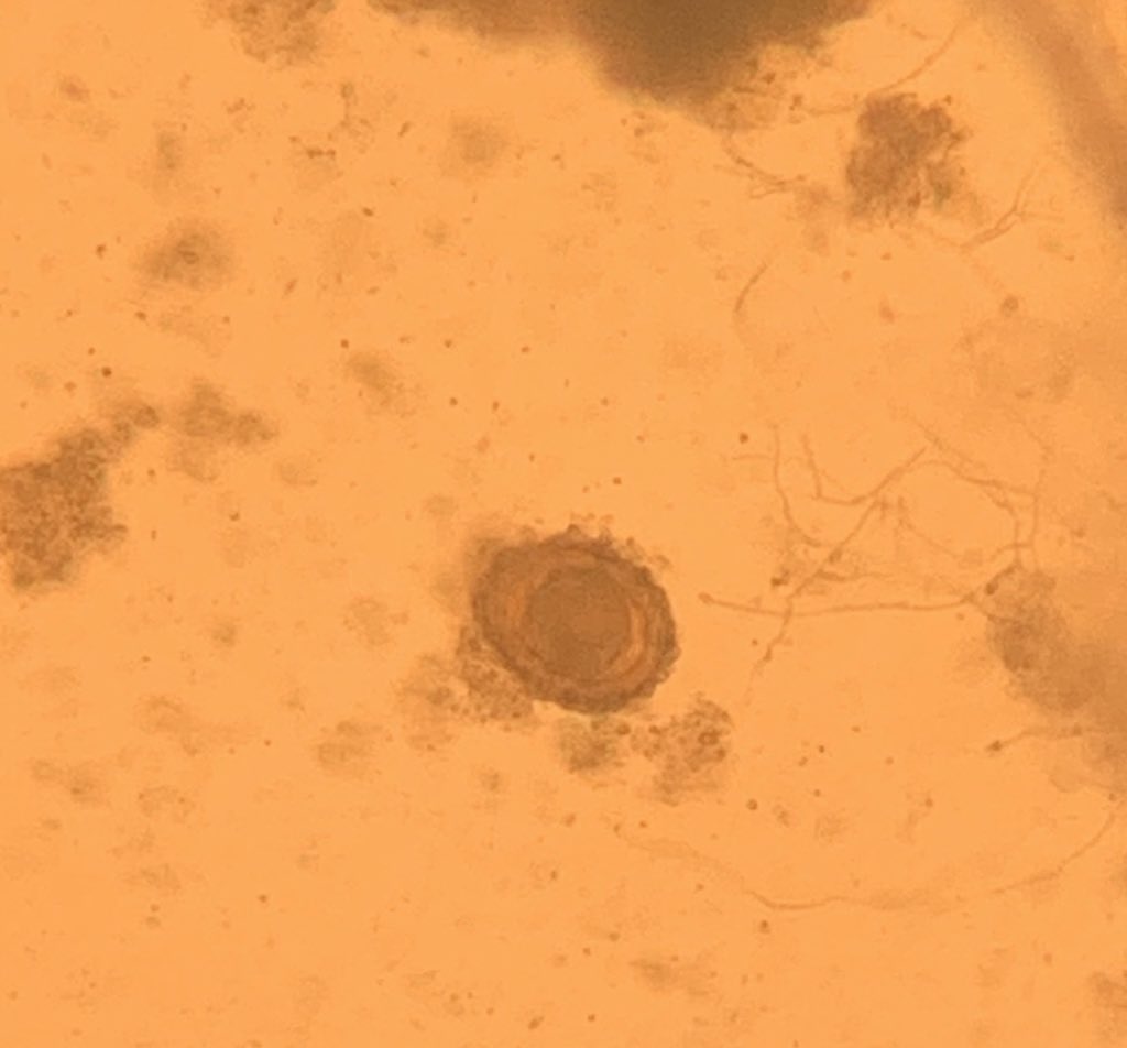 mehersingha's tweet image. Name the parasite in stool! #IDTwitter #GlobalHealth